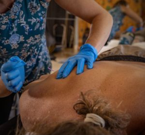 Understanding Dry Needling